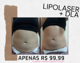 LIPOLASER + DLA