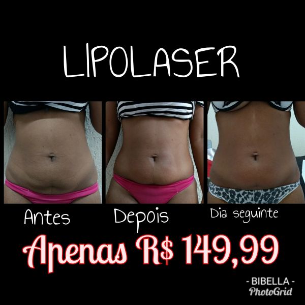 1 sessão de Lipolaser