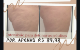 Tratamento intensivo para eliminar celulite.