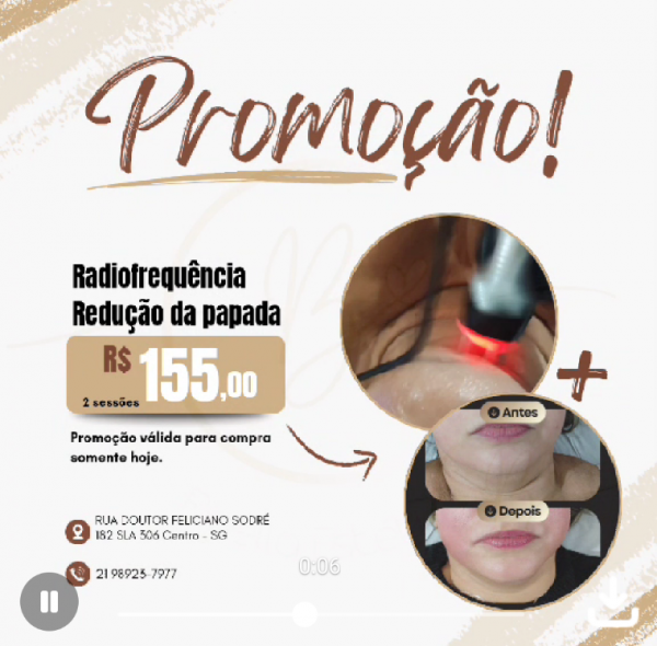 2 sessões de radiofrequência para redução da papada
