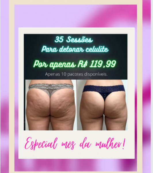 Especial mês da mulher ( 35 sessões para detonar Celulite)