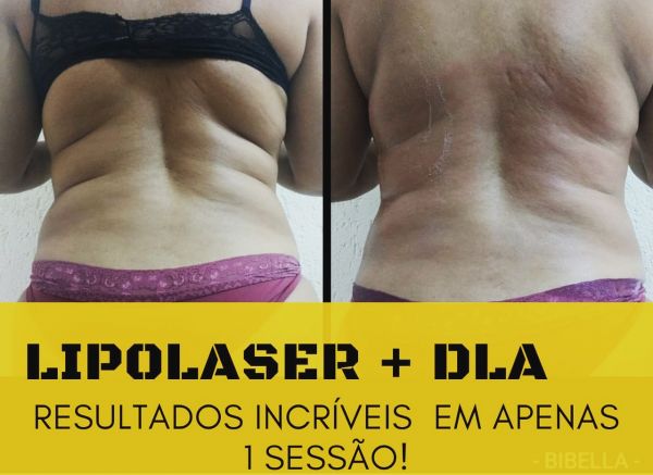 Lipolaser + DLA