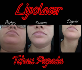 Lipolaser de papada ( 1 sessão)