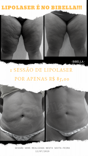 1 sessão de Lipolaser