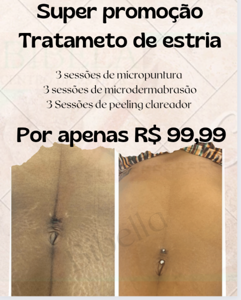 Super promoção ( tratamento de estrias)