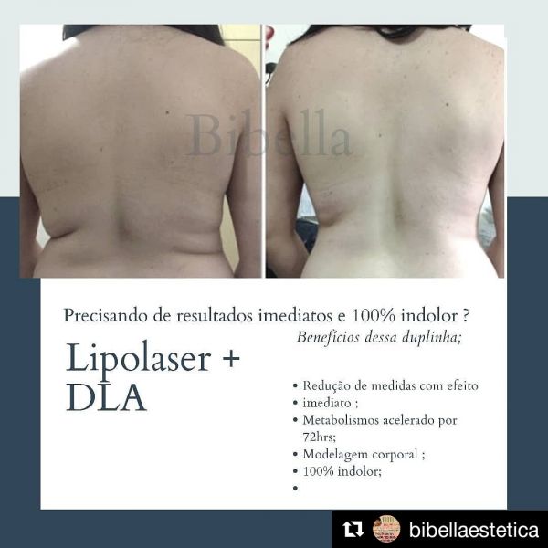 Lipolaser + DLA ( 1 SESSÃO)