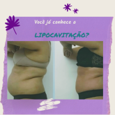 30 sessões com lipocavitacão: