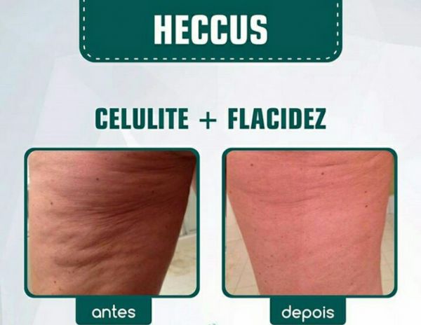 Heccus Para celulite e flacidez  em 18 sessões