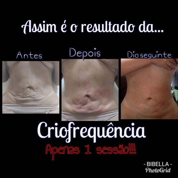 1 sessão de Criofrequência