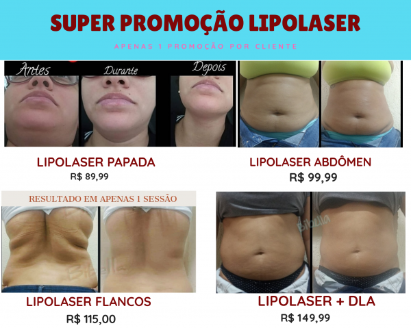 Lipolaser flancos