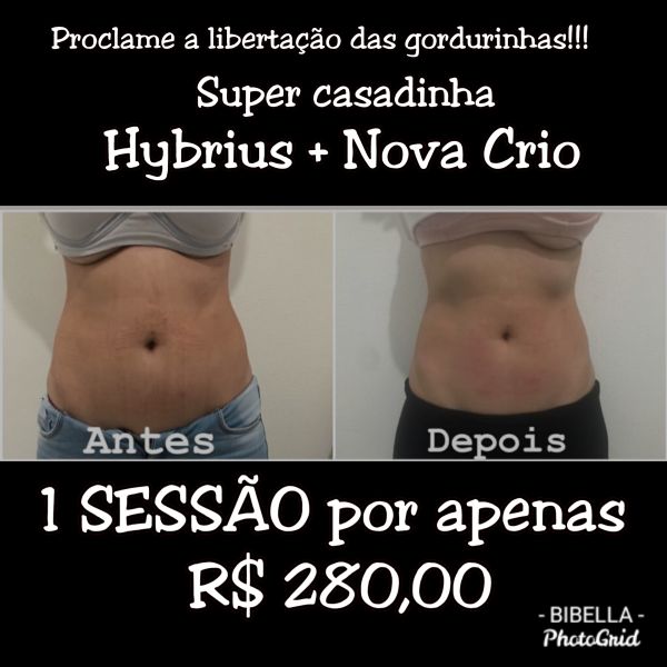 Casadinha Hybrius + nova CRIOLIPÓLISE