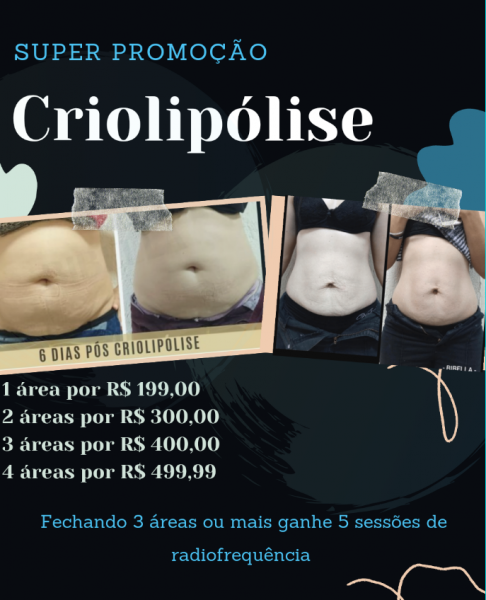 3 áreas de criolipólise