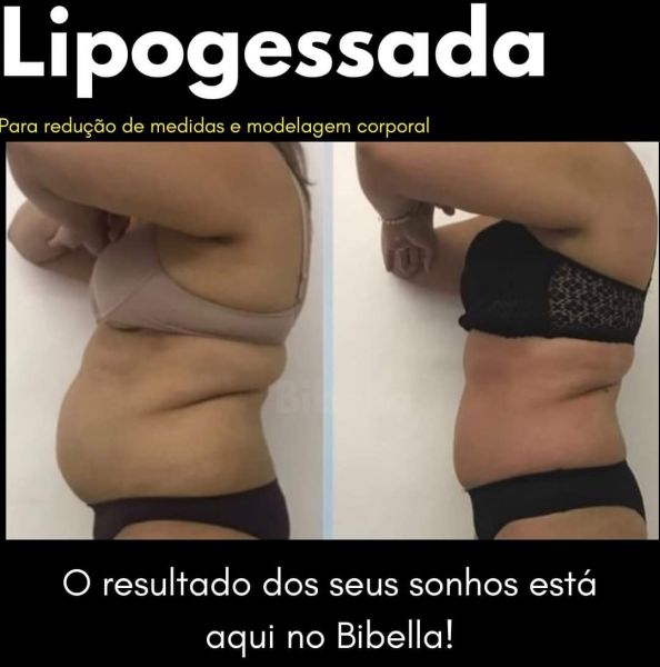 Lipogessada para modelar a silhueta