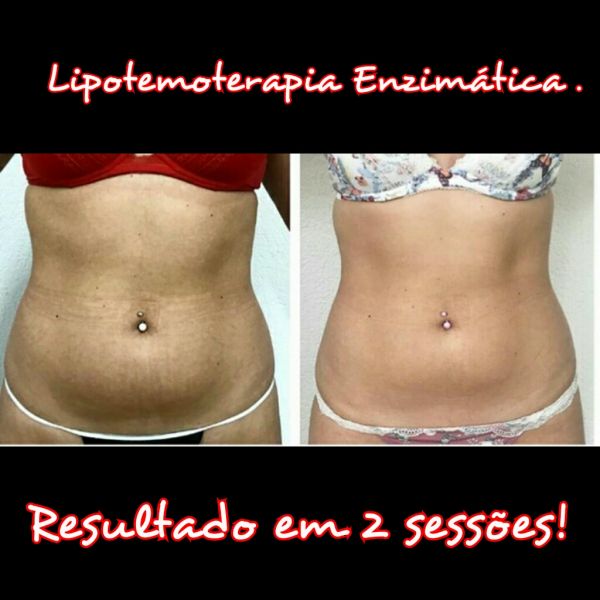 2sessões Lipotermoterapia Enzimática