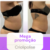 Mega promoção 1 área de Criolipolise