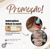 2 sessões de radiofrequência para redução da papada
