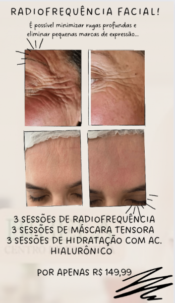 Rejuvenescimento facial com radiofrequência