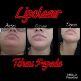 Lipolaser da papada