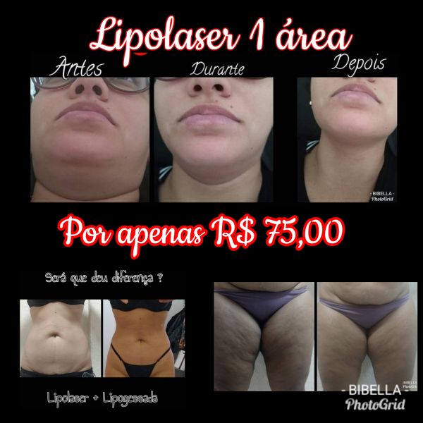 1 área de Lipolaser