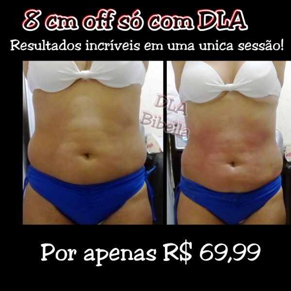 É possível reduzir 8cm em uma única sessão!