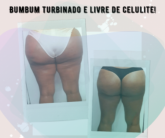 Bumbum turbinado e livre das celulites.