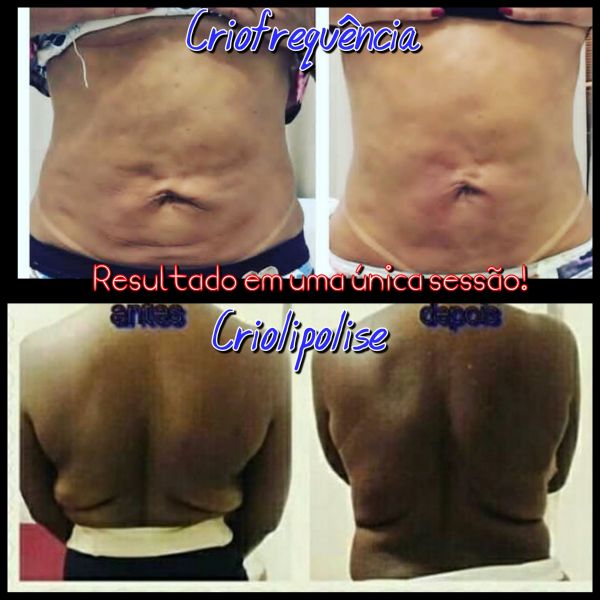 1 área de criolipolise +1 de Criofrequência + 1 de Lipolaser