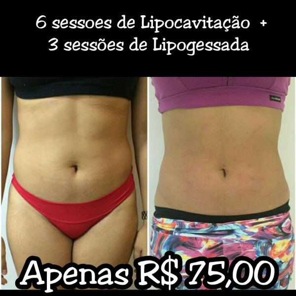 Lipocavitação + Lipogessada