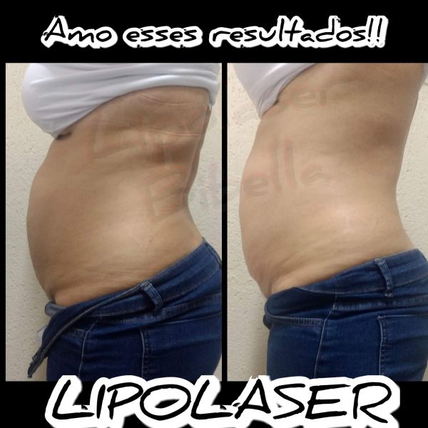 1 área de Lipolaser ( precinho especial)