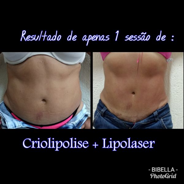 1 área de criolipolise +1 área de Lipolaser para vc e uma amiga