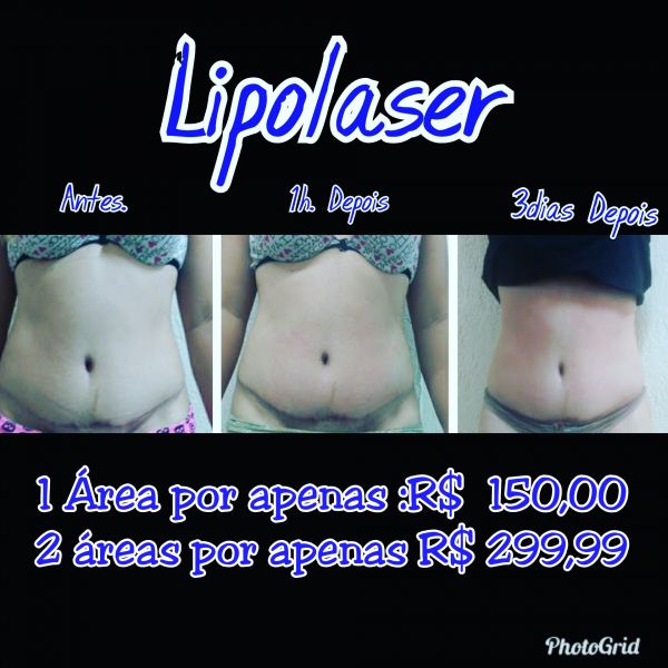 2 áreas de Lipolaser