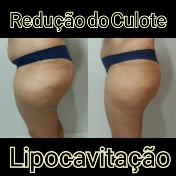 10 sessões de Lipo sem corte