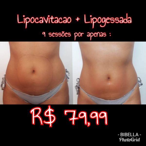 9 sessões com lipocavitacao e lipogessada