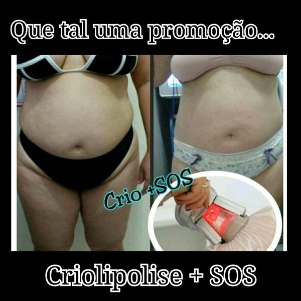 Criolipolise + SOS