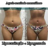 Redução de medidas com lipocavitação