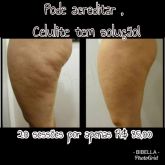 Celulite tem solução !!!