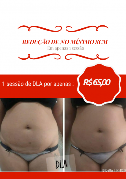 Redução de no mínimo 8cm em uma única sessão.