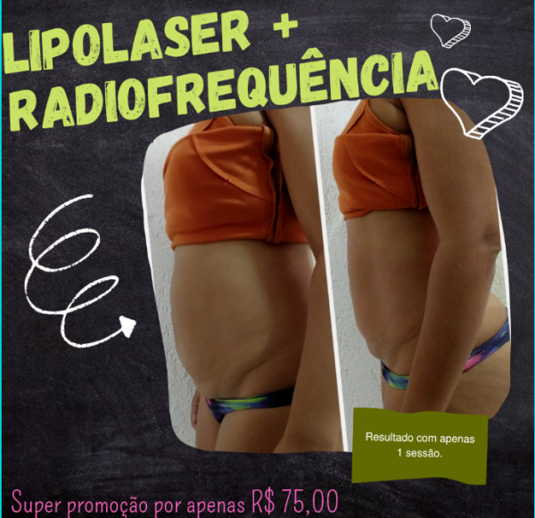 LIPOLASER + Radiofrequência