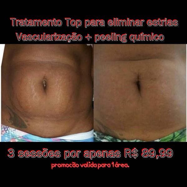 Tratamento top para detonar as estrias