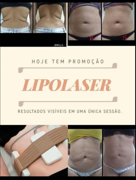 1 sessão de LIPOLASER no abdômen