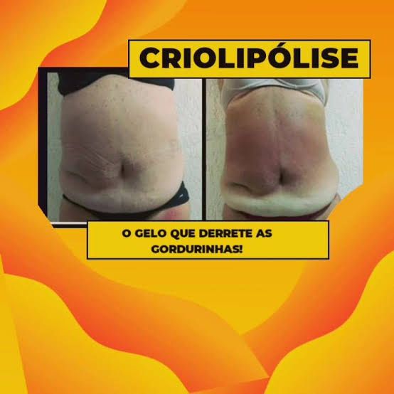 3 áreas de criolipólise